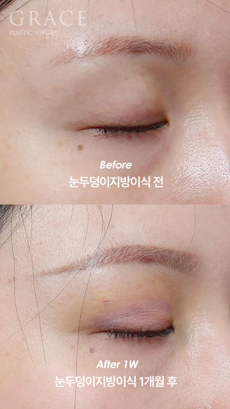 눈을 감았을 때 보이는 멍·흉터·울퉁불퉁함 걱정되나요? 눈두덩이 지방이식 관련 이미지 6
