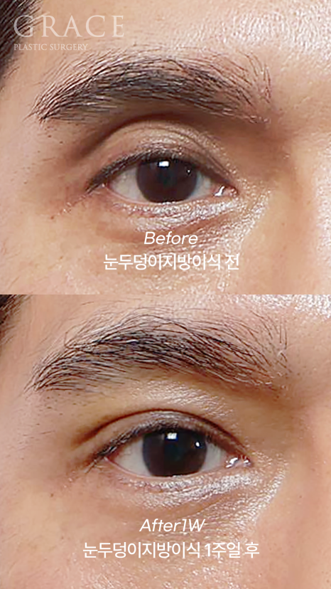 Male Brow Filler? Improvement with Eye-Hole Fat Grafting (Without Worrying About Side Effects, Scars, or Swelling) image 4