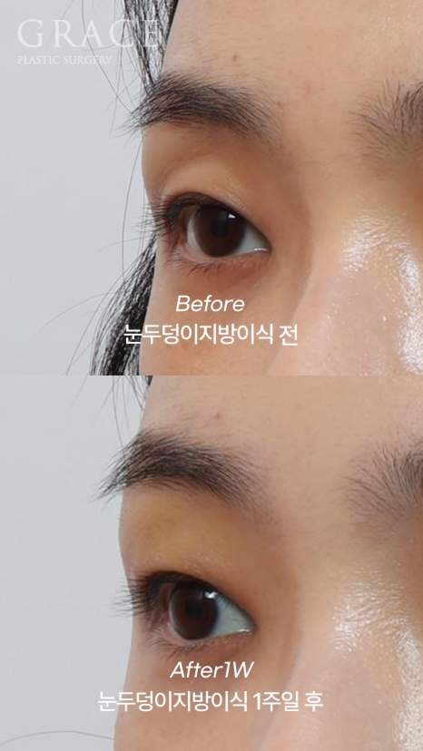 1 Week After Forehead Fat Grafting for Sunken Eyes: Honest Swelling Update image 3