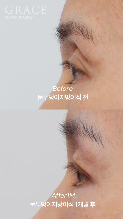 눈꺼풀 지방이식 절개 없이 아이홀 부위를 채우기 관련 이미지 4