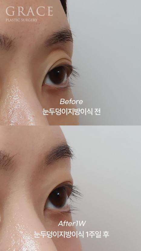 눈꺼풀 지방이식 잘하는 병원 그레이스성형외과 관련 이미지 5