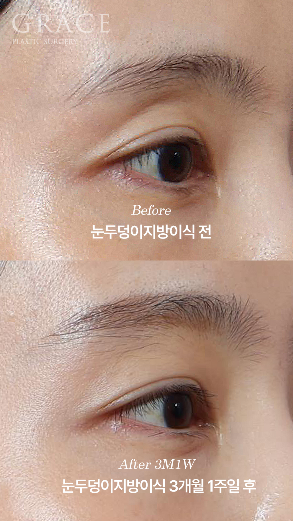 Why Choose Upper Eyelid Fat Grafting Instead of Eye-Hollow Filler? image 5