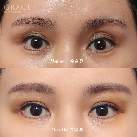 Will Swelling After Eyelid Fat Grafting Last a Long Time... Is It Really True? image 1
