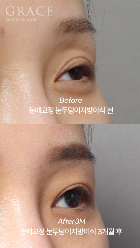 실패한 돌출눈성형 (눈매교정과 눈두덩이 지방이식) 관련 이미지 5