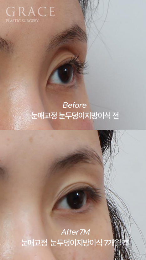 [20대 후반 눈꺼풀 지방이식+눈매교정]  7개월 후 유지력 이렇게 좋을 일? 관련 이미지 5