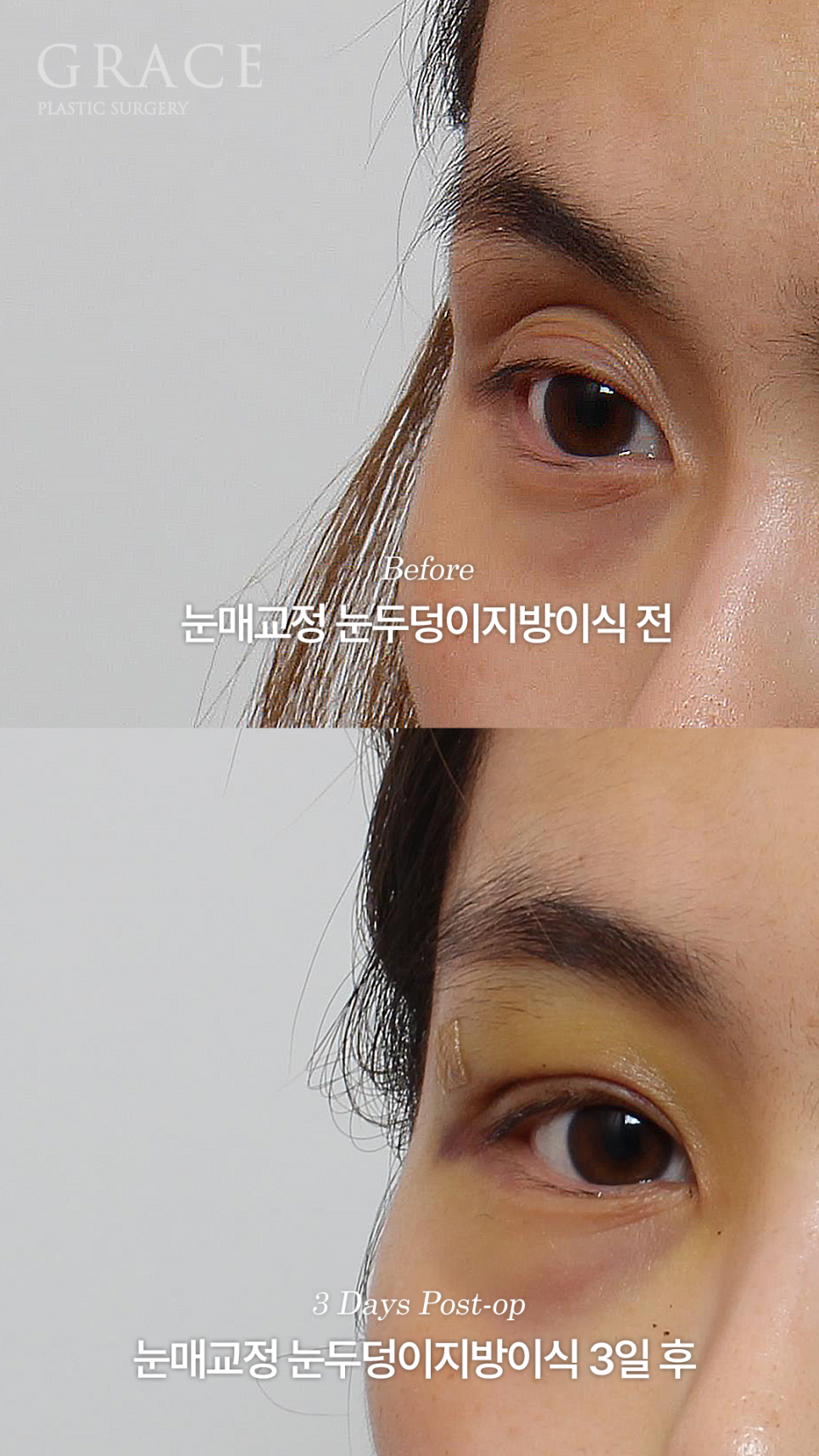 눈매교정 망하고 눈재수술 &middot; 눈두덩이 안와지방이식 관련 이미지 6