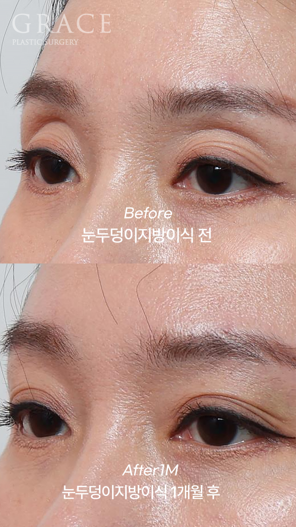 Upper Eyelid Fat Grafting Cost · Swelling, Reviews & Side Effects image 2