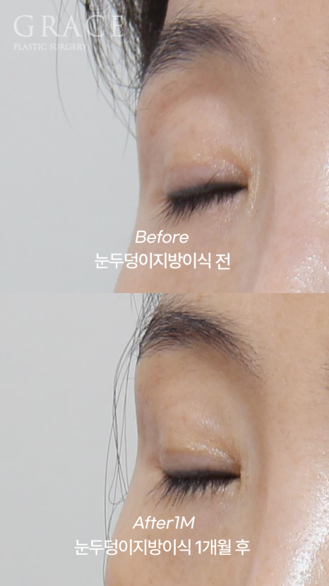 눈 위 지방이식 감으면 울퉁불퉁? 왜? 관련 이미지 5