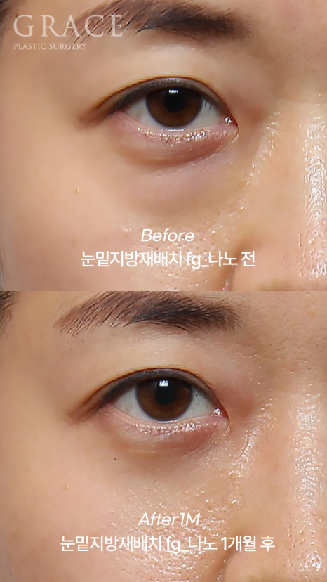 눈밑지방재배치 vs 눈두덩이지방이식｜부작용과 붓기 등 관련 이미지 2