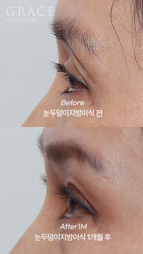 (2차 냉동지방 NO) 생지방으로 자연스럽게 채운 눈두덩이  붓기/부작용 걱정 없이 관련 이미지 7