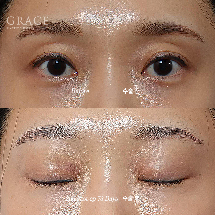 Will a Sunken Upper Eyelid Become Bumpy When You Close Your Eyes After Fat Grafting? image 8