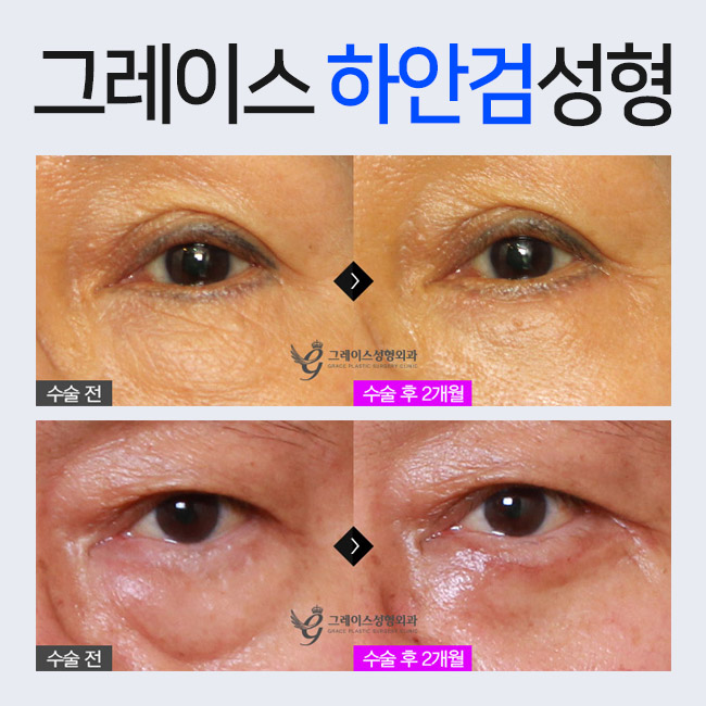 부모님 효도선물로 눈 밑 처짐을 해결해주는 하안검수술이 인기! 관련 이미지 4