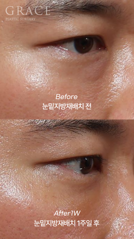 눈두덩이 지방이식 vs 눈밑지방재배치 (40대 중반 남자자&middot;비용&middot;붓기) 관련 이미지 4