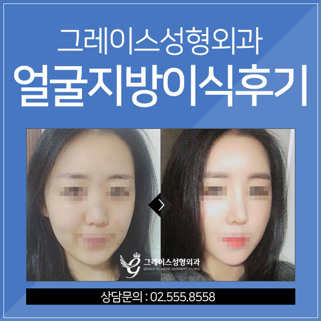 얼굴지방이식후기, 탄력있고 윤기있는 동안얼굴 관련 이미지 1