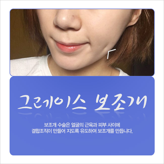 내 얼굴의 자연스러운 포인트! 그레이스 보조개수술 관련 이미지 3