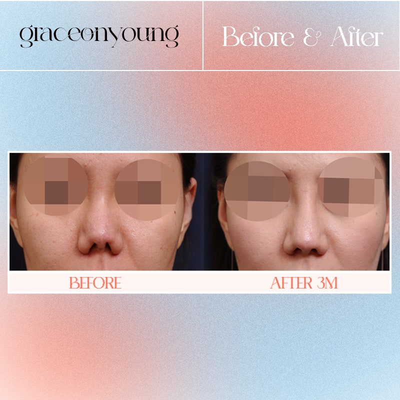 Advanced Nose Revision Surgery for Contracted Nose at Grace O&Young image 3