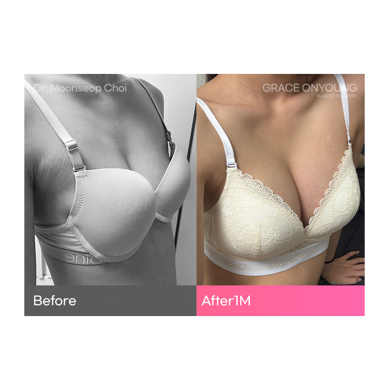 A Plastic Surgery Clinic That Does UU Line Breast Augmentation Well image 3