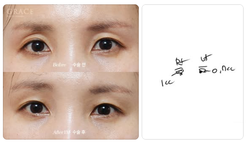 꺼진 아이홀 지방이식, 울퉁불퉁 부작용 오해 바로잡기 관련 이미지 1