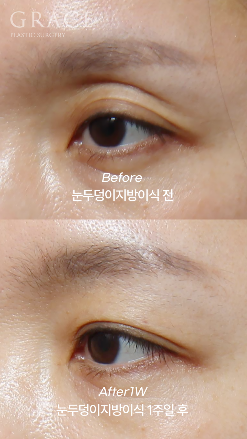 50대 눈꺼풀 지방이식 잘하는곳 염려되는 부작용 걱정까지 관련 이미지 6