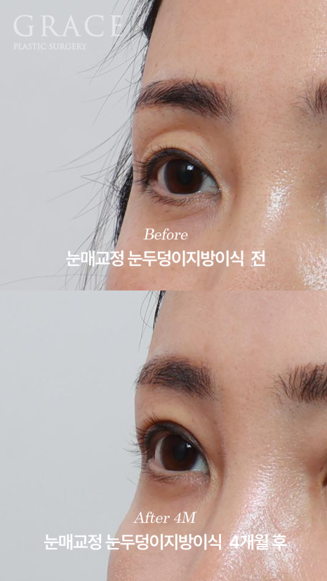 눈두덩이지방이식 11개월 후 부작용 없이 유지되는 변화 관련 이미지 4