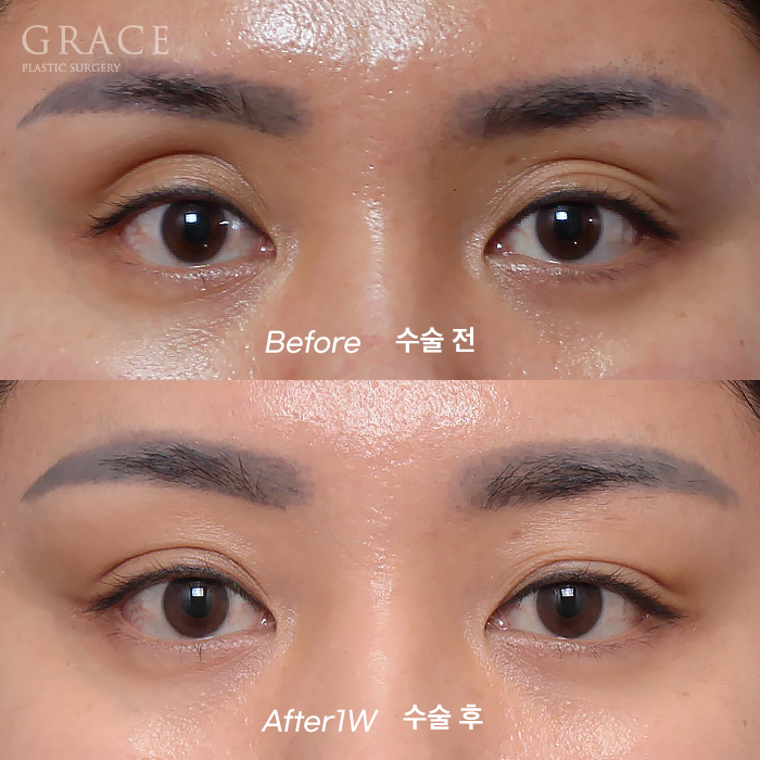 Before and After: Eyelid Fat Grafting Maintained for Over 2 Years in My Late 30s image 1