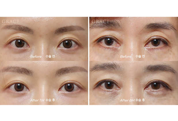 눈두덩이 지방이식 잘하는 병원? 의사 손에서 시작된다. 관련 이미지 5