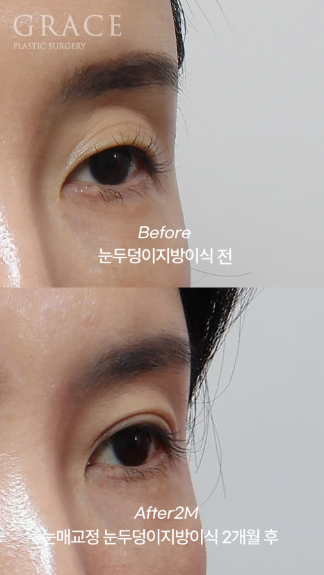 눈두덩이 지방이식 걱정만 덜기 관련 이미지 7