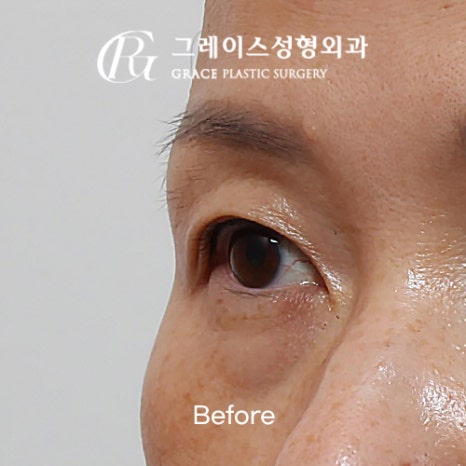 A Complete Guide to the Best Combination of Midlife Eye Surgery, from Under-Eye Fat Repositioning Costs to an I-Hole Filler Alternative image 5