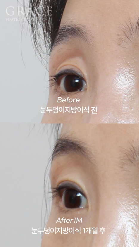 눈 위 지방이식 감으면 울퉁불퉁? 왜? 관련 이미지 2