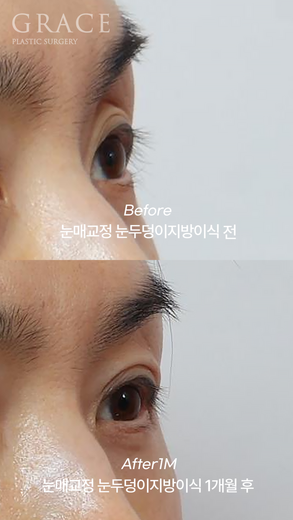 Sunken Upper Eyelids: Fillers or Fat Grafting? image 6