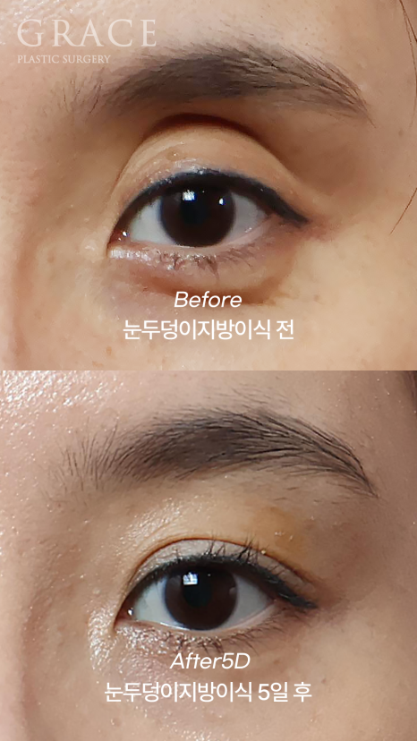 Upper Eyelid Fat Grafting, Yellow Bruising and Swelling (... Changes Noted After 5 Days) image 3