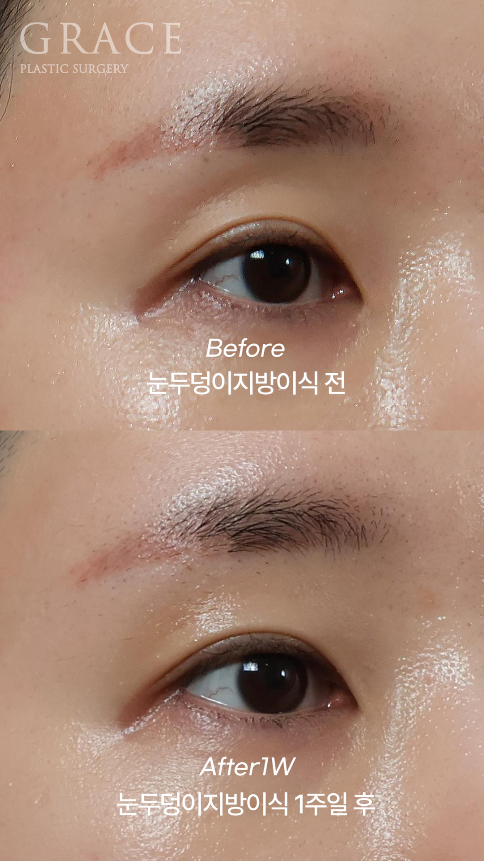 눈두덩이 지방이식 1주일 차 자연스러운 회복 중 관련 이미지 3