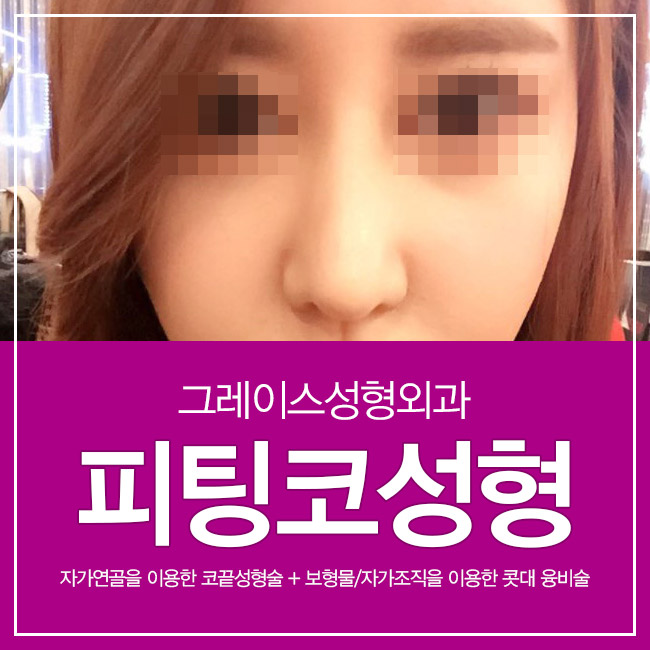 예쁜 라인과 자연스러운 움직임, 그레이스성형외과 피팅코성형 관련 이미지 5