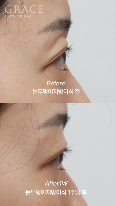No to Frozen Fat That’s Completely Frozen! Eyelid Fat Grafting with Only Fresh Autologous Fat image 5