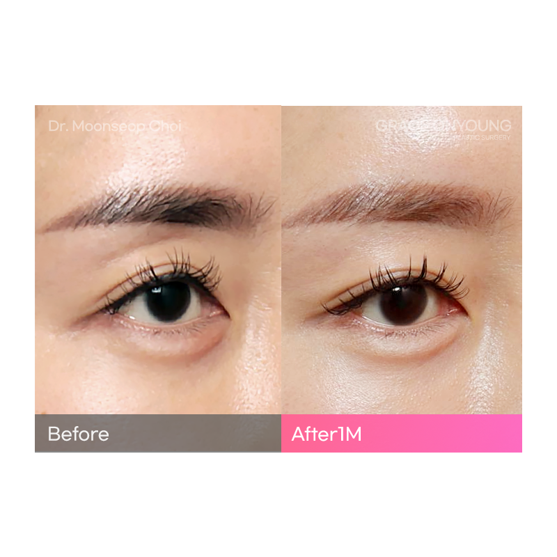 Are You Considering Fat Grafting for Hollow Upper Eyelids? image 7