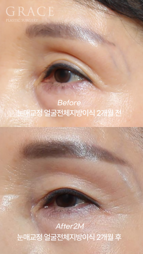In Your 50s, Restoring a Youthful Look with Before-and-After Eye Surgery and Fat Grafting to the Upper Eyelids, Temples, Under-Eyes, and Above the Brows image 5
