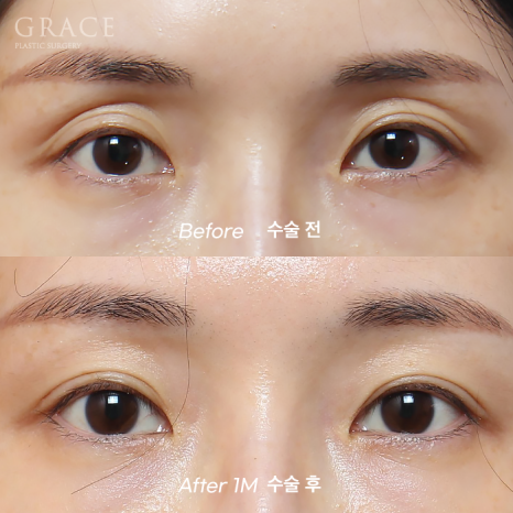 Eye Fat Grafting Instead of Eyelid Filler: Eye Shape Correction (1-Week Swelling Level) image 6