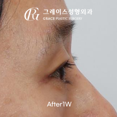 꺼진 눈 성형 1주일 붓기 보정 없이 솔직하게 보여드립니다 관련 이미지 6