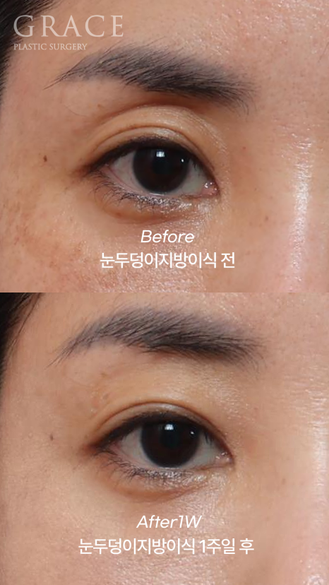 Week 1 After Upper Eyelid Fat Grafting in the Mid-40s: A Natural Return Without Swelling image 3