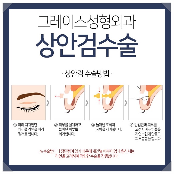 처진눈꺼풀을 해결하는 방법, 상안검수술후기 관련 이미지 4
