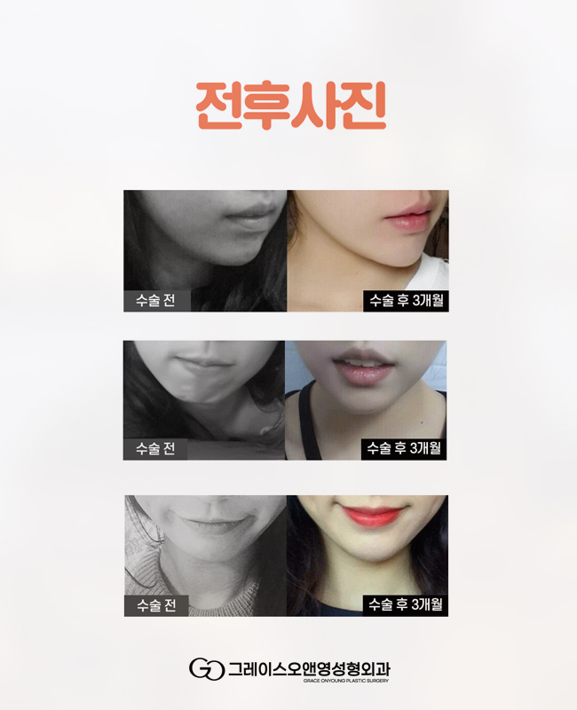 Chin Implant Surgery for a Natural Look, Even for Protruding Mouths image 6