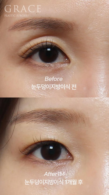 Eyebrow Hollow Fat Grafting Before and After Comparison – Gently Filling Sunken Eyes image 16