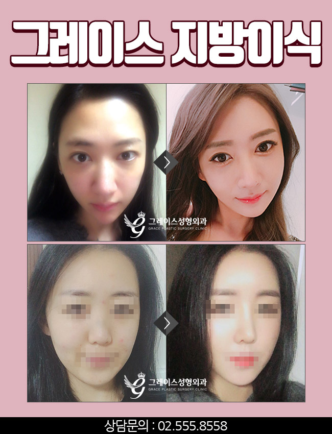 신사역 그레이스성형외과 지방이식으로 노안에서 탈출하자!! 관련 이미지 4
