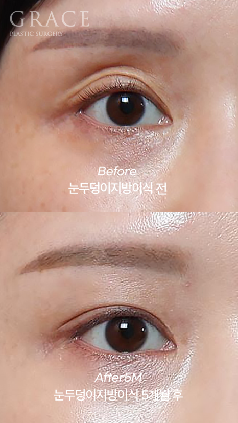 For Those Saddened by Sunken Eyelids (Upper-Eyelid Fat Grafting) image 1
