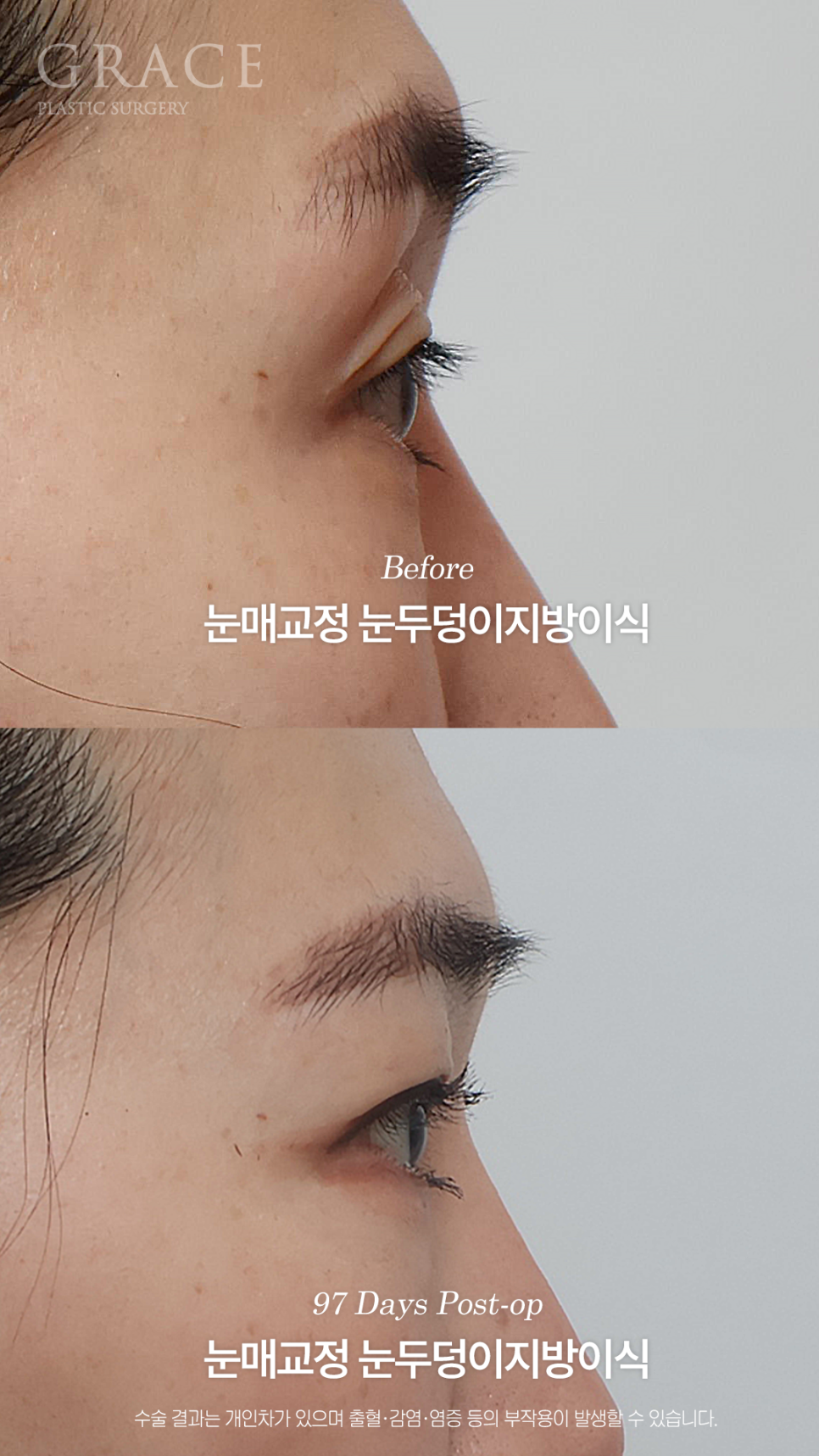 그레이스성형외과 눈두덩이 지방이식 1차로 끝내지 않은 진짜 이유 관련 이미지 8