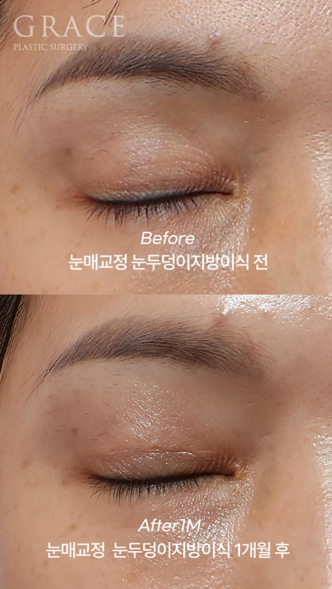 Is Eyelid Fat Grafting in Your 40s Required to Include Ptosis Correction? It Depends on Your Eye Condition image 2