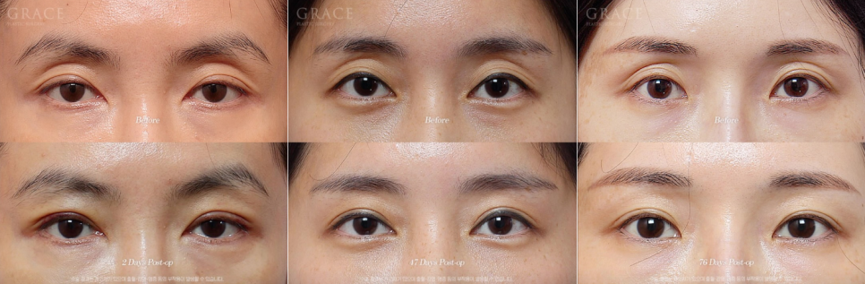 Looking into the Cost of Upper Eyelid Fat Grafting? What Really Matters Is More Than the Price..... image 2