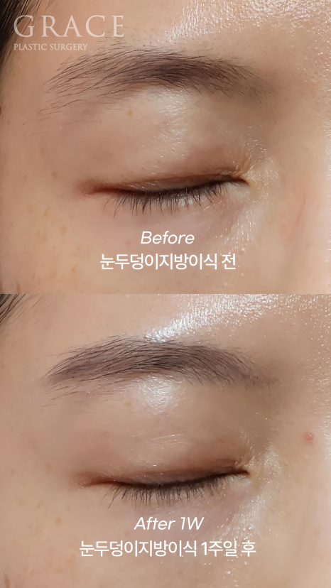 The Basis for a 94.5% Functional Improvement: Fat Grafting Technology That Fills in a Sunken Eye Hollow image 2