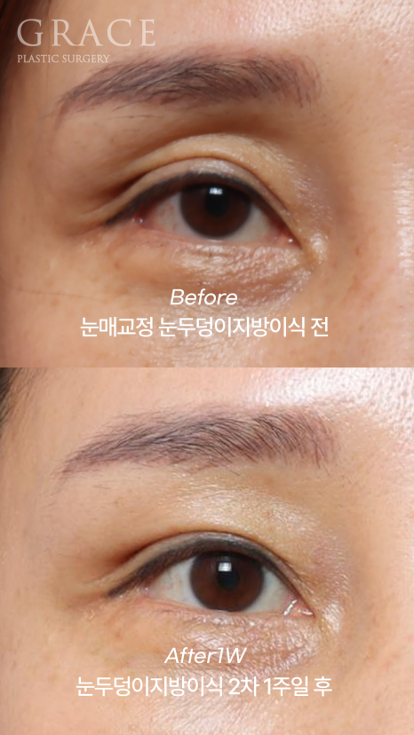 눈두덩이지방이식 2차 이식(리터치) 마취&지방채취 부위 등 관련 이미지 1