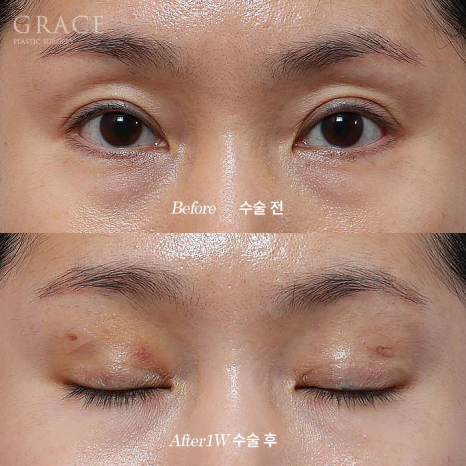 Why Choose Upper Eyelid Fat Grafting Instead of Eye-Hollow Filler? image 3